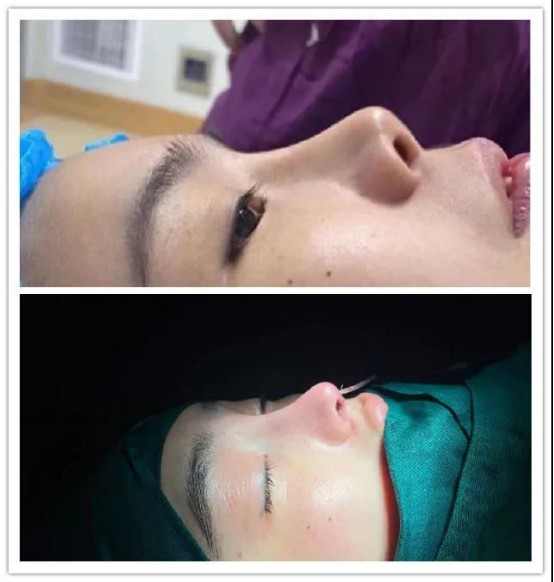 南京艺星美容潘峰主任以个性化设计精细化手术著称，被誉为鼻修复达人